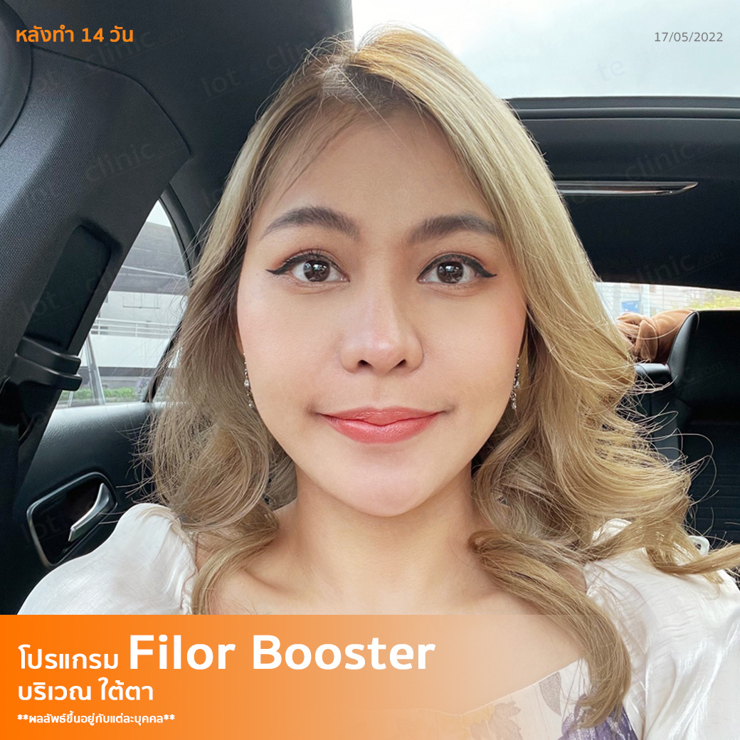 โบกมือลา...ใต้ตาคล้ำ ด้วยโปรแกรม Filor Booster