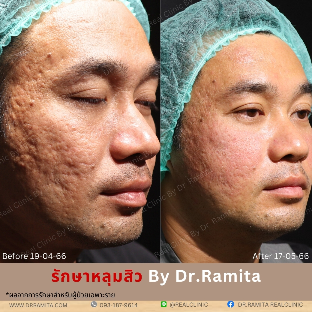 รักษาหลุมสิว,ตัดพังผืด,รักษาหลุมสิว, วิธีรักษาหลุมสิว, Fractional Laser, Microneedling, Subcision, เติมฟิลเลอร์, Real Scar Synergy, Juvgen,acnescarsurgery,acnescarrevision,รักษาหลุมสิวให้ตื้น,เลเซอร์หลุมสิว, รักษาหลุมสิวที่ดีที่สุด,รักษาหลุมสิวให้หายขาด,หลุมสิว,realclinic,drramita
