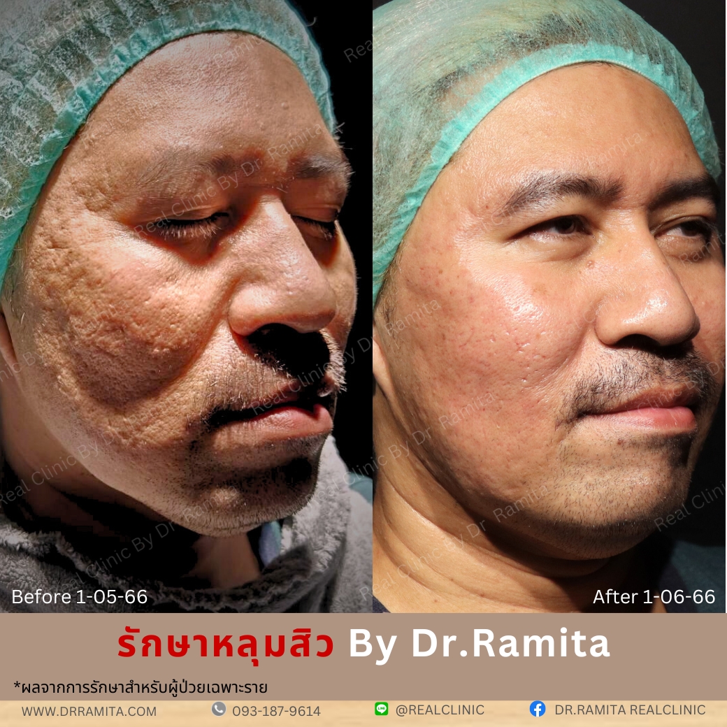 รักษาหลุมสิว,ตัดพังผืด,รักษาหลุมสิว, วิธีรักษาหลุมสิว, Fractional Laser, Microneedling, Subcision, เติมฟิลเลอร์, Real Scar Synergy, Juvgen,acnescarsurgery,acnescarrevision,รักษาหลุมสิวให้ตื้น,เลเซอร์หลุมสิว, รักษาหลุมสิวที่ดีที่สุด,รักษาหลุมสิวให้หายขาด,หลุมสิว,realclinic,drramita รักษาหลุมสิว,ตัดพังผืด,รักษาหลุมสิว, วิธีรักษาหลุมสิว, Fractional Laser, Microneedling, Subcision, เติมฟิลเลอร์, Real Scar Synergy, Juvgen,acnescarsurgery,acnescarrevision,รักษาหลุมสิวให้ตื้น,เลเซอร์หลุมสิว, รักษาหลุมสิวที่ดีที่สุด,รักษาหลุมสิวให้หายขาด,หลุมสิว,realclinic,drramita