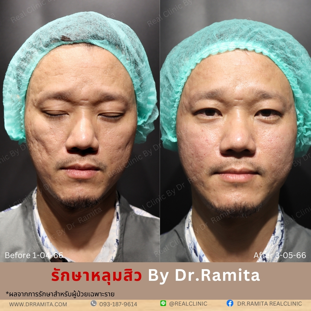รักษาหลุมสิว,ตัดพังผืด,รักษาหลุมสิว, วิธีรักษาหลุมสิว, Fractional Laser, Microneedling, Subcision, เติมฟิลเลอร์, Real Scar Synergy, Juvgen,acnescarsurgery,acnescarrevision,รักษาหลุมสิวให้ตื้น,เลเซอร์หลุมสิว, รักษาหลุมสิวที่ดีที่สุด,รักษาหลุมสิวให้หายขาด,หลุมสิว,realclinic,drramita รักษาหลุมสิว,ตัดพังผืด,รักษาหลุมสิว, วิธีรักษาหลุมสิว, Fractional Laser, Microneedling, Subcision, เติมฟิลเลอร์, Real Scar Synergy, Juvgen,acnescarsurgery,acnescarrevision,รักษาหลุมสิวให้ตื้น,เลเซอร์หลุมสิว, รักษาหลุมสิวที่ดีที่สุด,รักษาหลุมสิวให้หายขาด,หลุมสิว,realclinic,drramita
