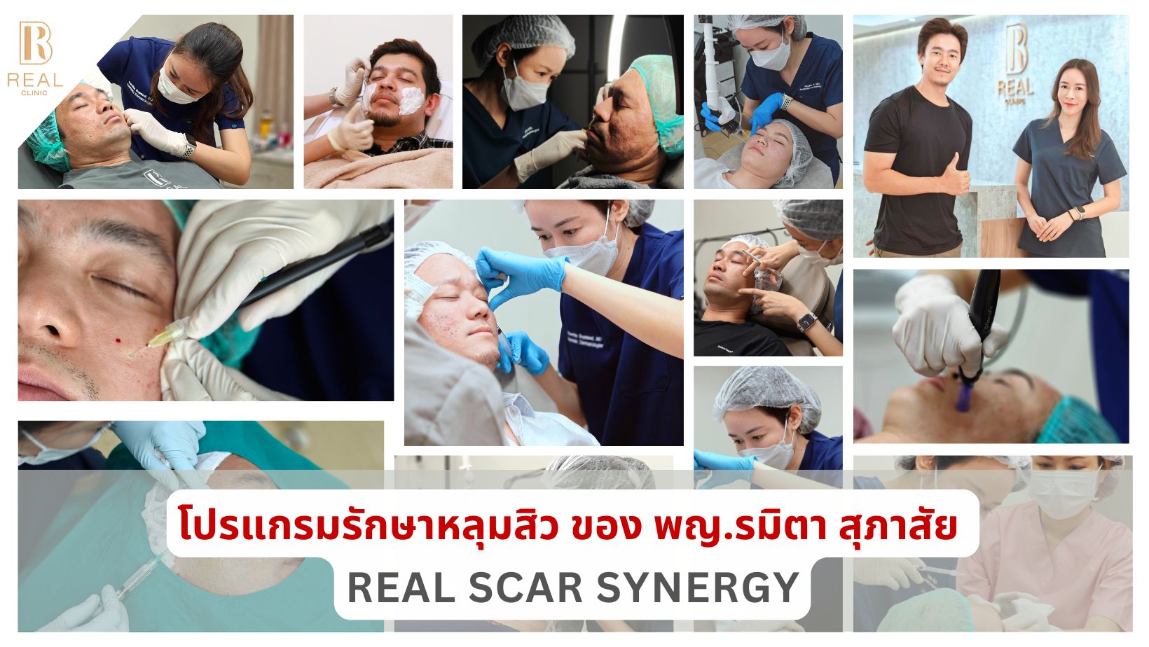 รักษาหลุมสิว,ตัดพังผืด,รักษาหลุมสิว, วิธีรักษาหลุมสิว, Fractional Laser, Microneedling, Subcision, เติมฟิลเลอร์, Real Scar Synergy, Juvgen,acnescarsurgery,acnescarrevision,รักษาหลุมสิวให้ตื้น,เลเซอร์หลุมสิว, รักษาหลุมสิวที่ดีที่สุด,รักษาหลุมสิวให้หายขาด,ห รักษาหลุมสิว,ตัดพังผืด,รักษาหลุมสิว, วิธีรักษาหลุมสิว, Fractional Laser, Microneedling, Subcision, เติมฟิลเลอร์, Real Scar Synergy, Juvgen,acnescarsurgery,acnescarrevision,รักษาหลุมสิวให้ตื้น,เลเซอร์หลุมสิว, รักษาหลุมสิวที่ดีที่สุด,รักษาหลุมสิวให้หายขาด,ห