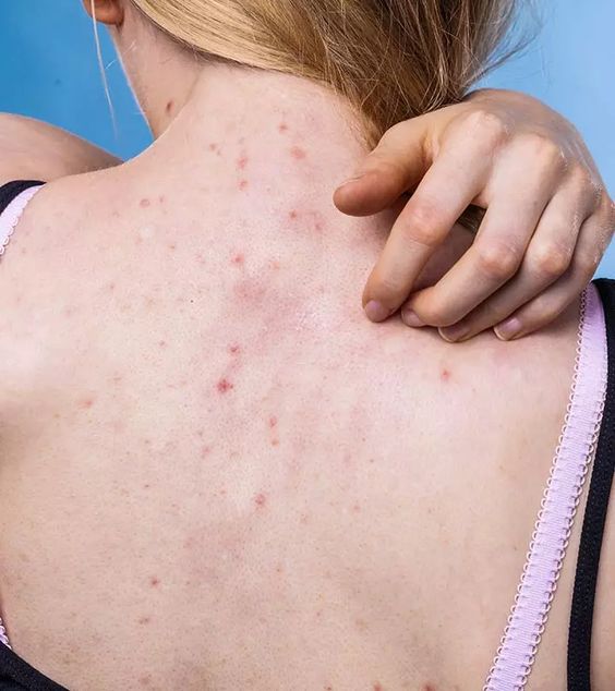 ปัญหาเเละสาเหตุของปัญหาสิวยีสต์ สิวยีสต์เป็นอีกหนึ่งสาเหตุที่ทำให้เกิดผิวเเพ้ง่าย