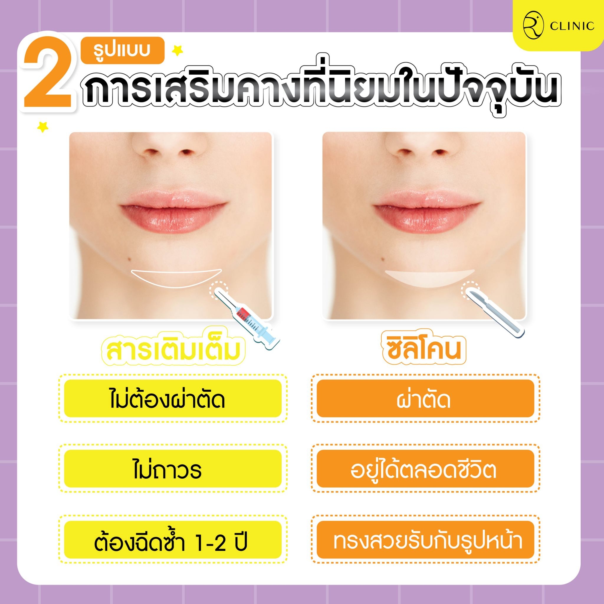 การเสริมคางที่นิยม