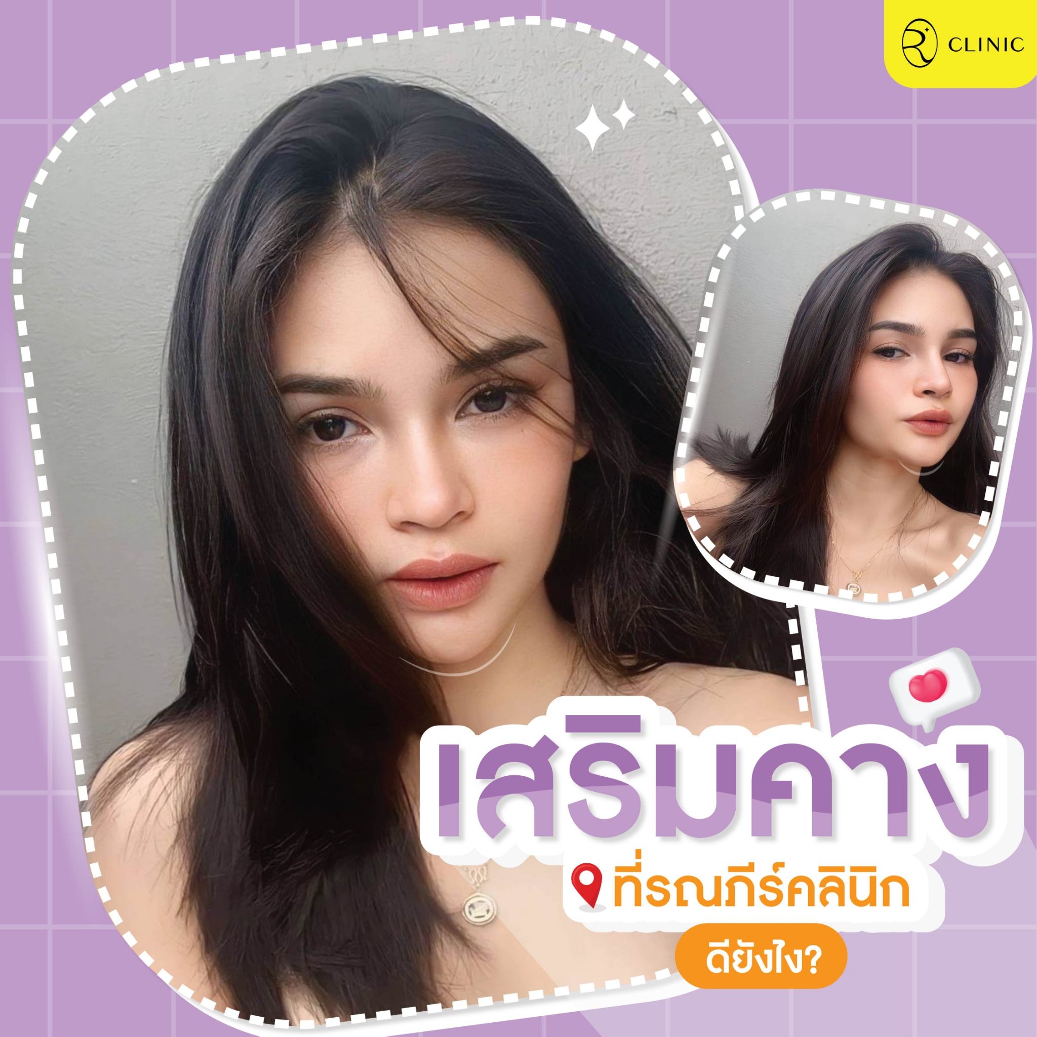 เสริมคางดียังไง