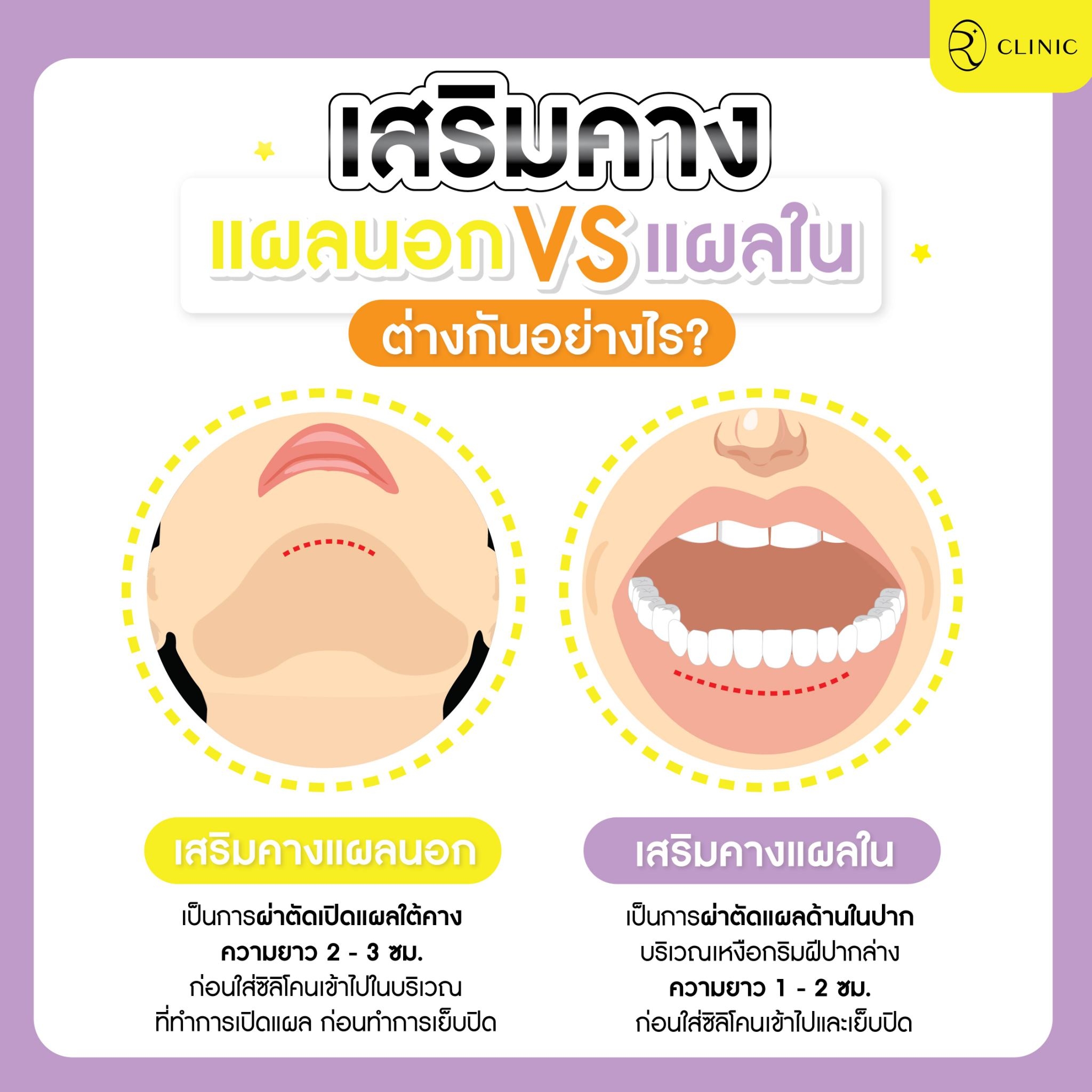 แผลเสริมคาง