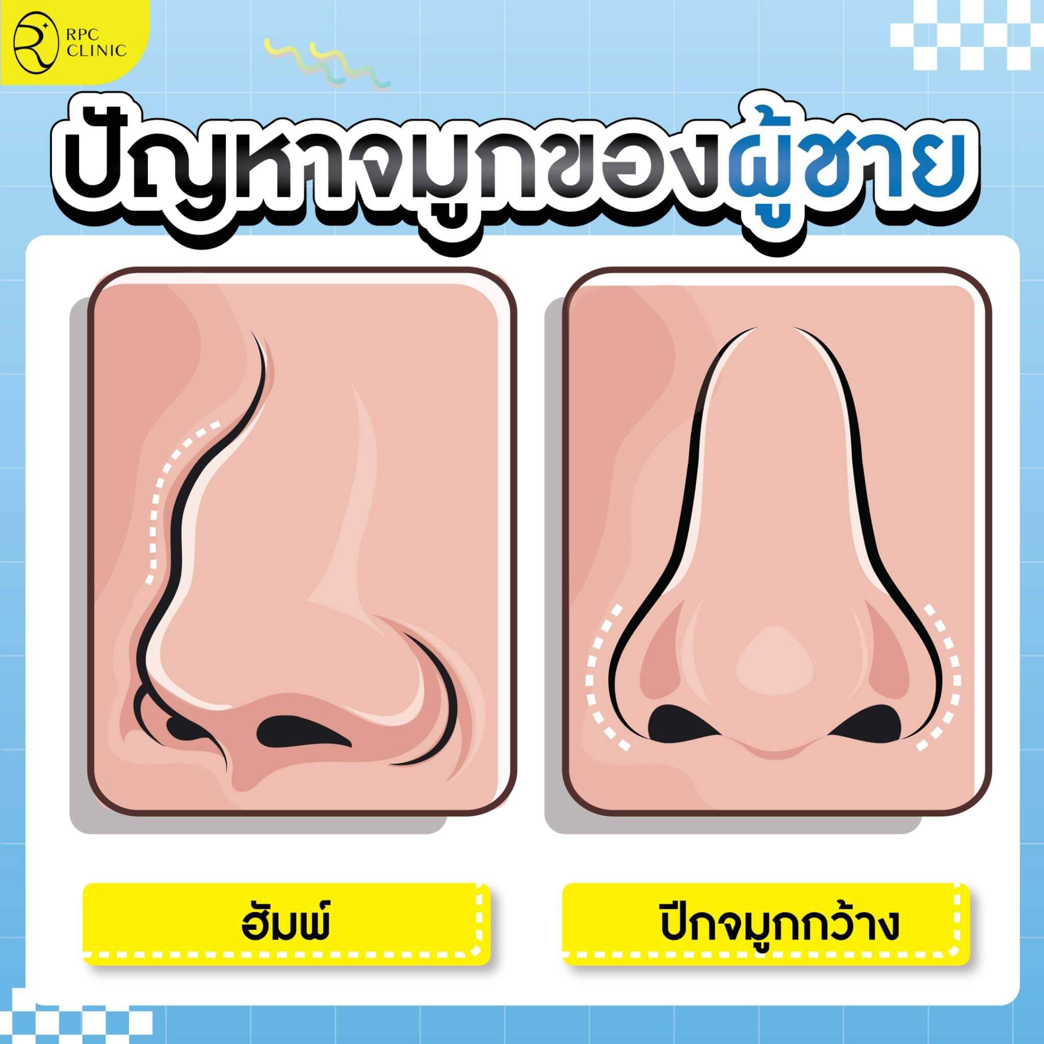 ปัญหาจมูกผู้ชาย