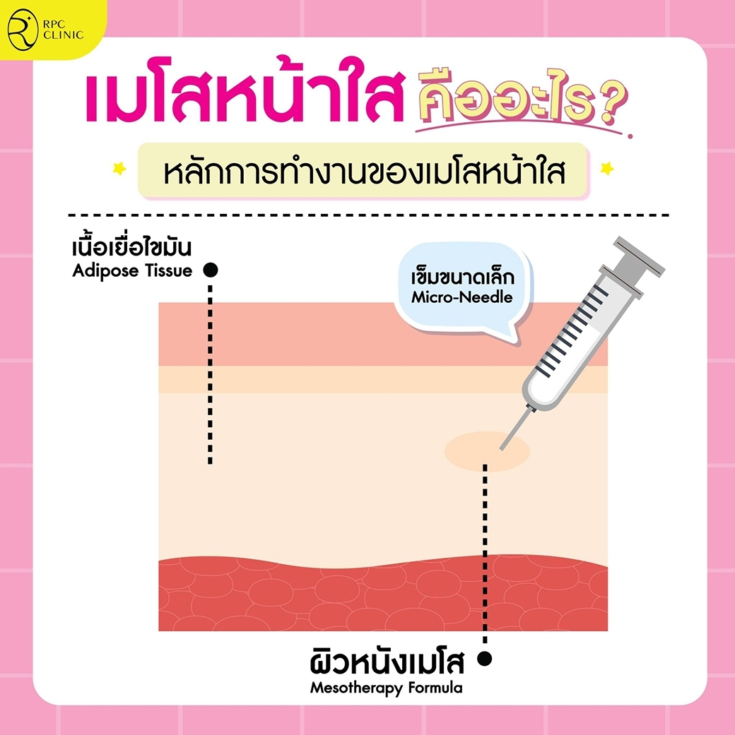 เมโสหน้าใส_คืออะไร