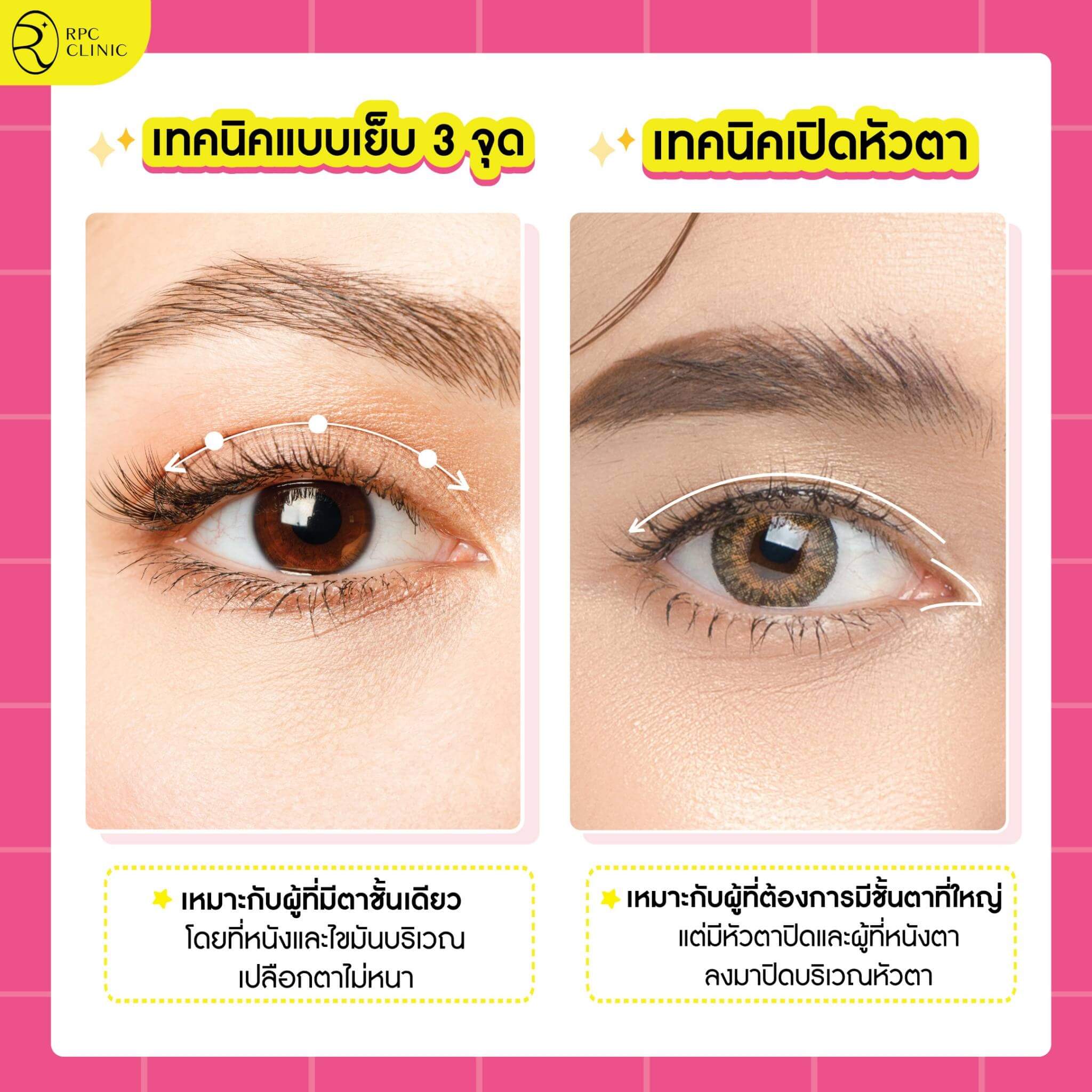 เทคนิคทำตาสองชั้น