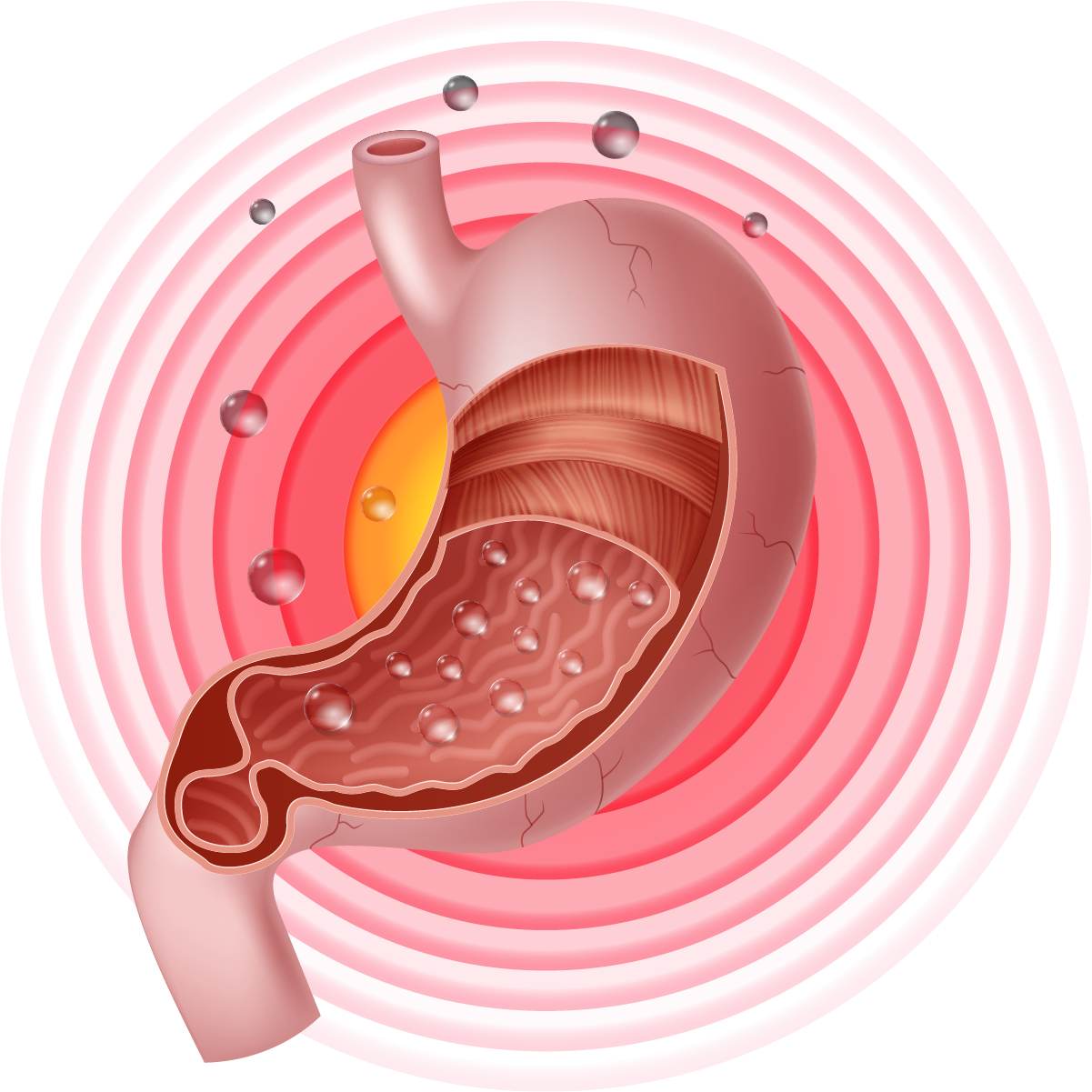 โรคกรดไหลย้อน โรคกระเพาะ GRD