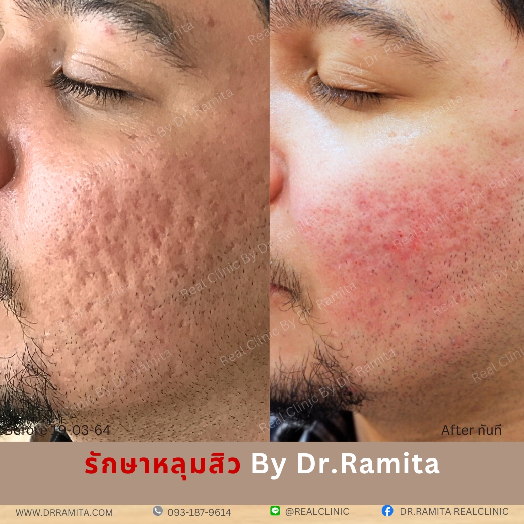 รักษาหลุมสิว,ตัดพังผืด,รักษาหลุมสิว, วิธีรักษาหลุมสิว, Fractional Laser, Microneedling, Subcision, เติมฟิลเลอร์, Real Scar Synergy, Juvgen,acnescarsurgery,acnescarrevision,รักษาหลุมสิวให้ตื้น,เลเซอร์หลุมสิว, รักษาหลุมสิวที่ดีที่สุด,รักษาหลุมสิวให้หายขาด,หลุมสิว,realclinic,drramita ฟิลเลอร์หลุมสิว ฉีดฟิลเลอร์หลุมสิว รักษาหลุมสิว,ตัดพังผืด,รักษาหลุมสิว, วิธีรักษาหลุมสิว, Fractional Laser, Microneedling, Subcision, เติมฟิลเลอร์, Real Scar Synergy, Juvgen,acnescarsurgery,acnescarrevision,รักษาหลุมสิวให้ตื้น,เลเซอร์หลุมสิว, รักษาหลุมสิวที่ดีที่สุด,รักษาหลุมสิวให้หายขาด,หลุมสิว,realclinic,drramita