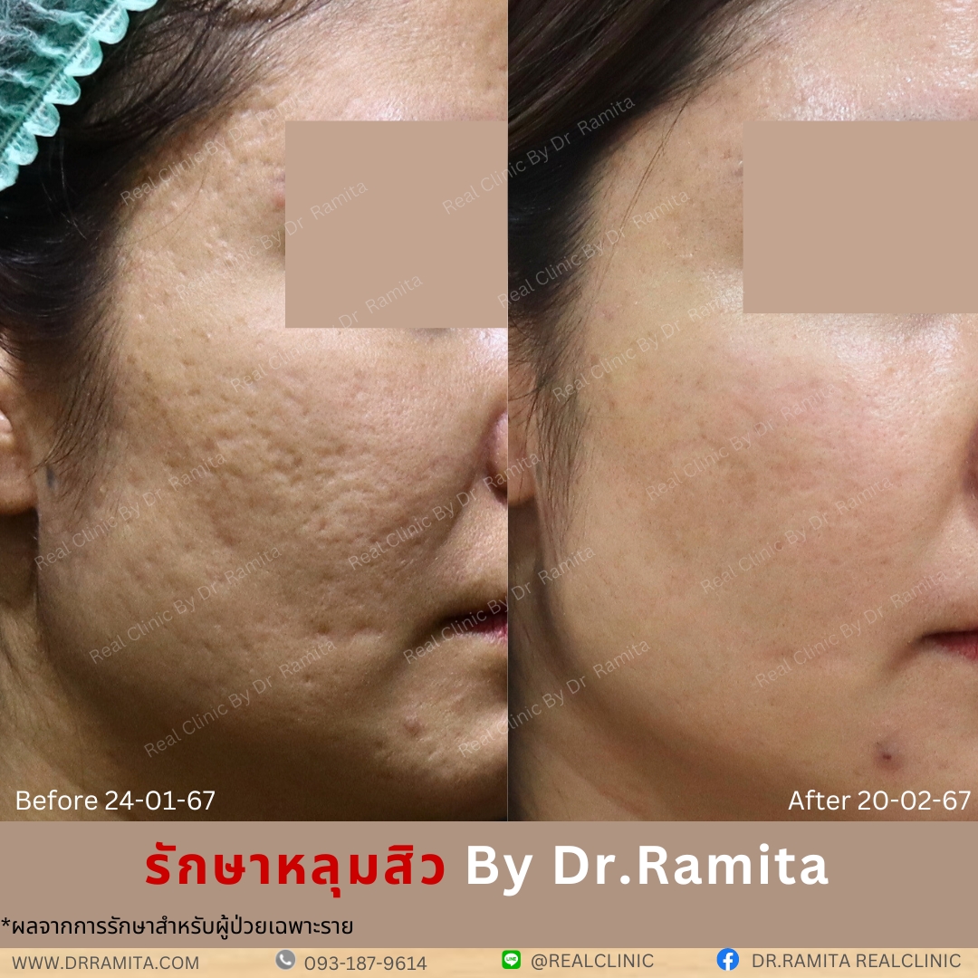 real scar synergy juvgen หลุมสิวเกาหลี ดร.จิน รักษาหลุมสิว ศัลยกรรมหลุมสิว ฟื้นฟูหลุมสิว real scar synergy juvgen หลุมสิวเกาหลี ดร.จิน รักษาหลุมสิว ศัลยกรรมหลุมสิว ฟื้นฟูหลุมสิว