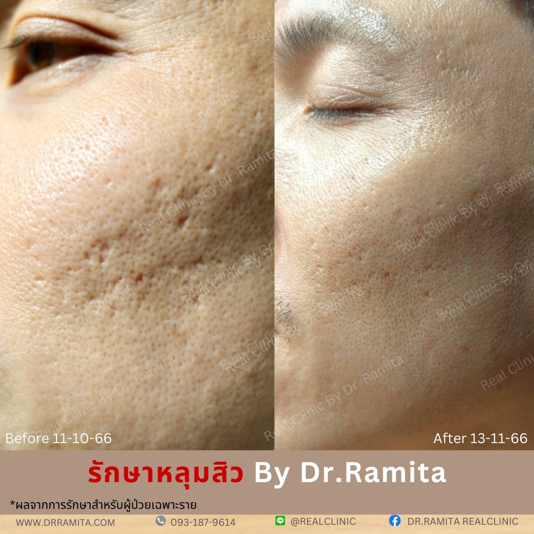 real scar synergy juvgen หลุมสิวเกาหลี ดร.จิน รักษาหลุมสิว ศัลยกรรมหลุมสิว ฟื้นฟูหลุมสิว real scar synergy juvgen หลุมสิวเกาหลี ดร.จิน รักษาหลุมสิว ศัลยกรรมหลุมสิว ฟื้นฟูหลุมสิว