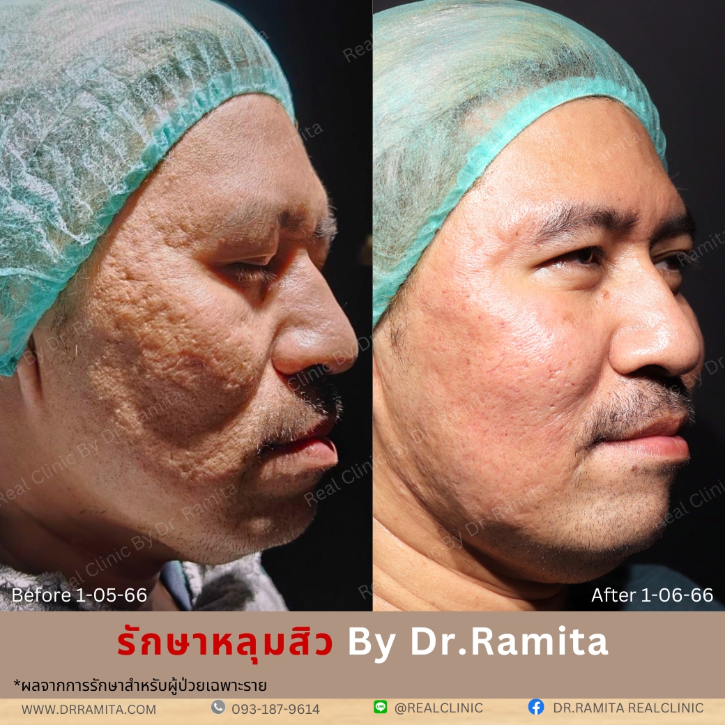 real scar synergy juvgen หลุมสิวเกาหลี ดร.จิน รักษาหลุมสิว ศัลยกรรมหลุมสิว ฟื้นฟูหลุมสิว real scar synergy juvgen หลุมสิวเกาหลี ดร.จิน รักษาหลุมสิว ศัลยกรรมหลุมสิว ฟื้นฟูหลุมสิว