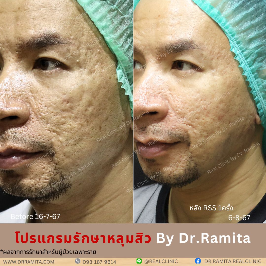 รักษาหลุมสิว,ตัดพังผืด,รักษาหลุมสิว, วิธีรักษาหลุมสิว, Fractional Laser, Microneedling, Subcision, เติมฟิลเลอร์, Real Scar Synergy, Juvgen,acnescarsurgery,acnescarrevision,รักษาหลุมสิวให้ตื้น,เลเซอร์หลุมสิว, รักษาหลุมสิวที่ดีที่สุด,รักษาหลุมสิวให้หายขาด,หลุมสิว,realclinic,drramita รักษาหลุมสิว,ตัดพังผืด,รักษาหลุมสิว, วิธีรักษาหลุมสิว, Fractional Laser, Microneedling, Subcision, เติมฟิลเลอร์, Real Scar Synergy, Juvgen,acnescarsurgery,acnescarrevision,รักษาหลุมสิวให้ตื้น,เลเซอร์หลุมสิว, รักษาหลุมสิวที่ดีที่สุด,รักษาหลุมสิวให้หายขาด,หลุมสิว,realclinic,drramita
