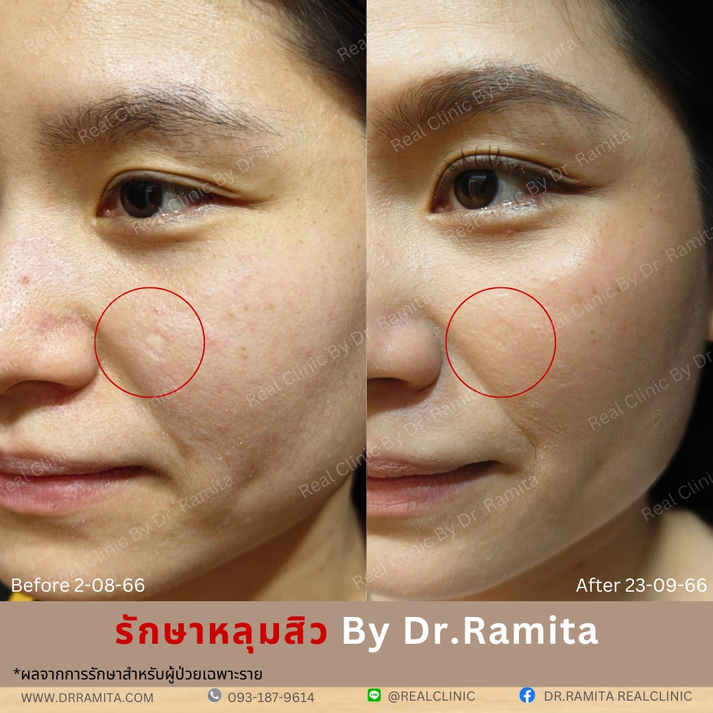 real scar synergy juvgen หลุมสิวเกาหลี ดร.จิน รักษาหลุมสิว ศัลยกรรมหลุมสิว ฟื้นฟูหลุมสิว real scar synergy juvgen หลุมสิวเกาหลี ดร.จิน รักษาหลุมสิว ศัลยกรรมหลุมสิว ฟื้นฟูหลุมสิว