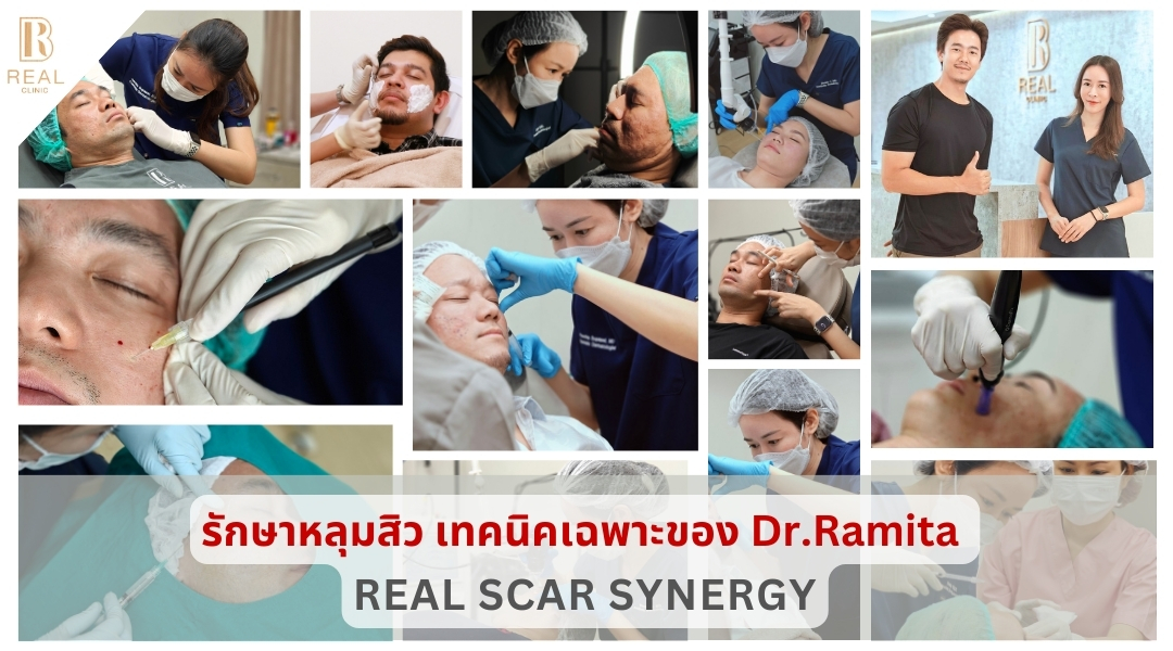 ฟิลเลอร์หลุมสิว ฉีดฟิลเลอร์หลุมสิว fillerหลุมสิว เติมเต็มหลุมสิว ดรจินหลุมสิว หลุมสิวเกาหลี ฟิลเลอร์หลุมสิว ฉีดฟิลเลอร์หลุมสิว fillerหลุมสิว เติมเต็มหลุมสิว ดรจินหลุมสิว หลุมสิวเกาหลี