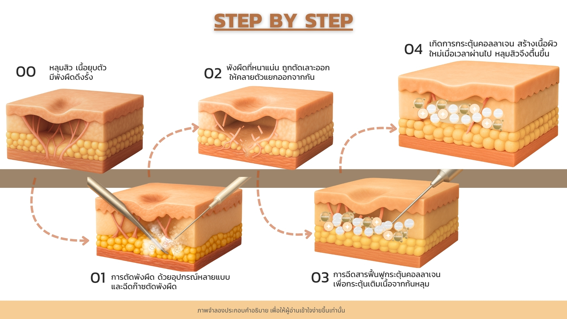 5R Acne Scar