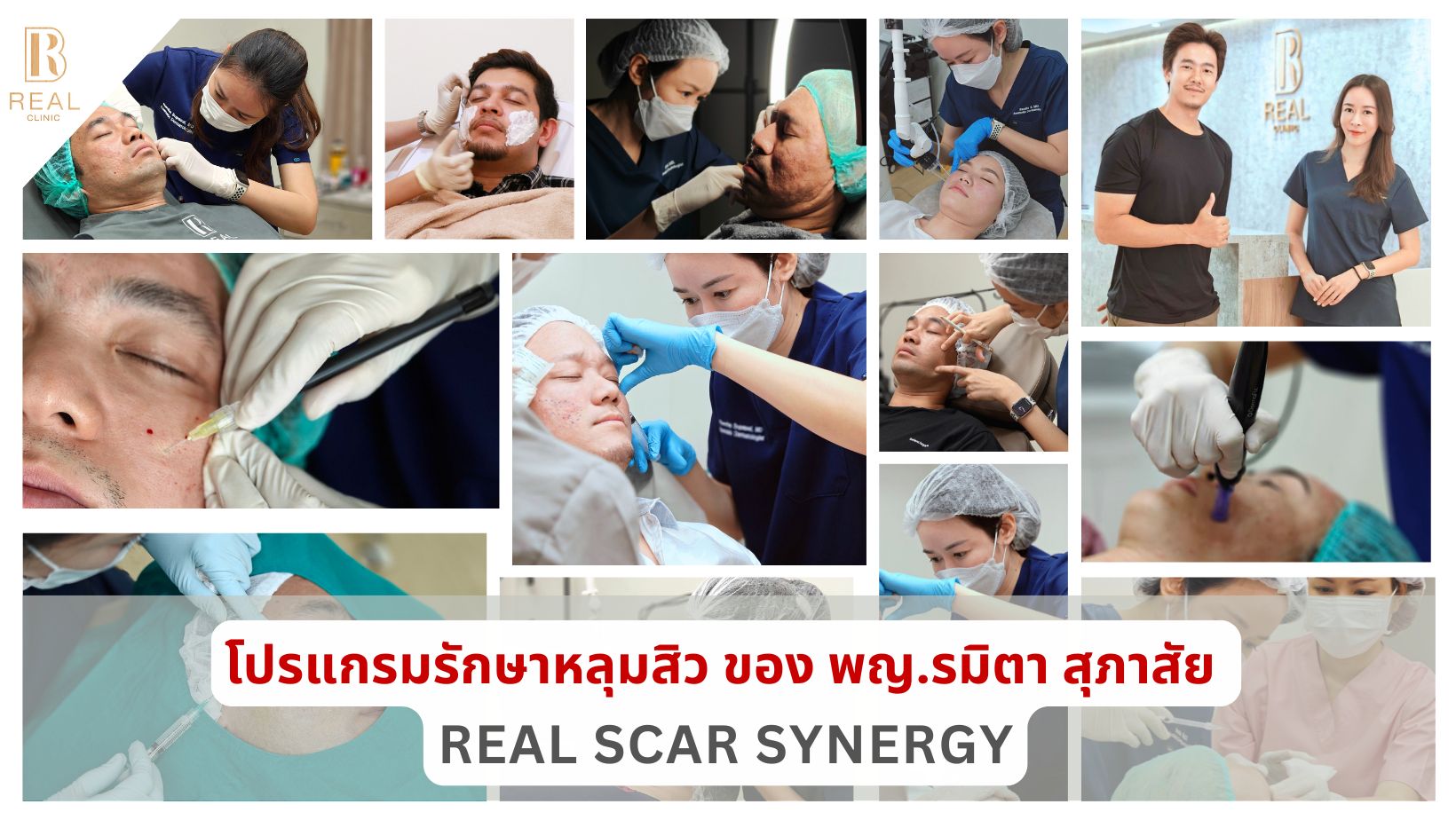 รักษาหลุมสิว,ตัดพังผืด,รักษาหลุมสิว, วิธีรักษาหลุมสิว, Fractional Laser, Microneedling, Subcision, เติมฟิลเลอร์, Real Scar Synergy, Juvgen,acnescarsurgery,acnescarrevision,รักษาหลุมสิวให้ตื้น,เลเซอร์หลุมสิว, รักษาหลุมสิวที่ดีที่สุด,รักษาหลุมสิวให้หายขาด,หลุมสิว,realclinic,drramita