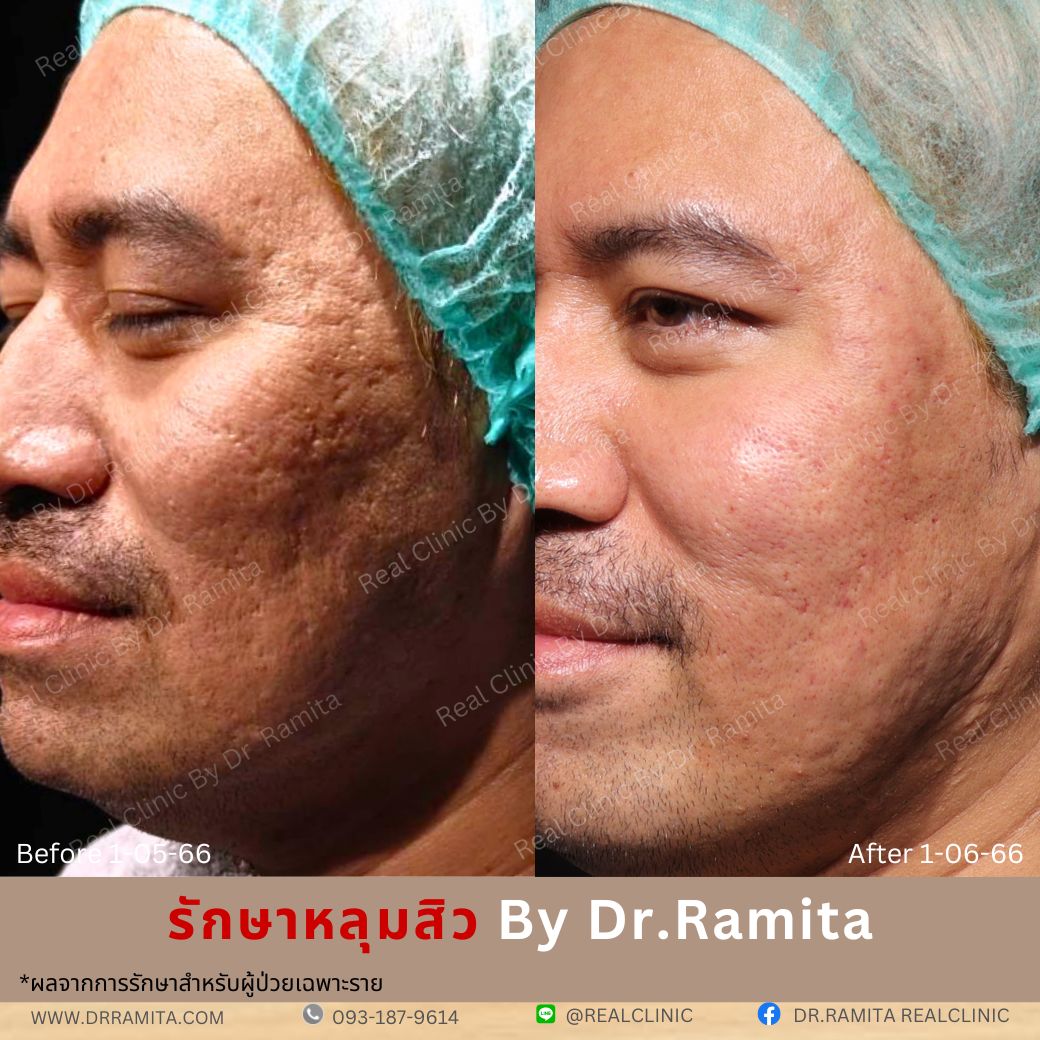 รักษาหลุมสิว,ตัดพังผืด,รักษาหลุมสิว, วิธีรักษาหลุมสิว, Fractional Laser, Microneedling, Subcision, เติมฟิลเลอร์, Real Scar Synergy, Juvgen,acnescarsurgery,acnescarrevision,รักษาหลุมสิวให้ตื้น,เลเซอร์หลุมสิว, รักษาหลุมสิวที่ดีที่สุด,รักษาหลุมสิวให้หายขาด,หลุมสิว,realclinic,drramita รักษาหลุมสิว,ตัดพังผืด,รักษาหลุมสิว, วิธีรักษาหลุมสิว, Fractional Laser, Microneedling, Subcision, เติมฟิลเลอร์, Real Scar Synergy, Juvgen,acnescarsurgery,acnescarrevision,รักษาหลุมสิวให้ตื้น,เลเซอร์หลุมสิว, รักษาหลุมสิวที่ดีที่สุด,รักษาหลุมสิวให้หายขาด,หลุมสิว,realclinic,drramita