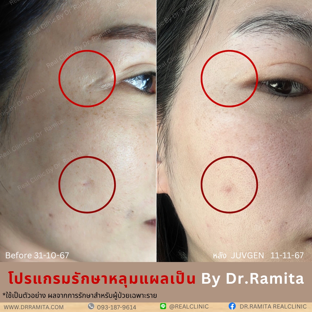 juvgen หลุมสิวเกาหลี รักษาหลุมสิว ศัลยกรรมหลุมสิว real scar synergy dr ramita 