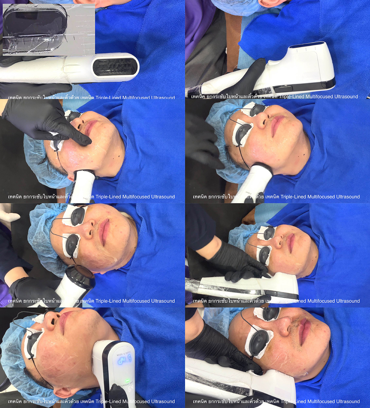 เทคนิค ยกกระชับใบหน้าและคิ้วด้วย เทคนิค  Triple-Lined Multifocused Ultrasound