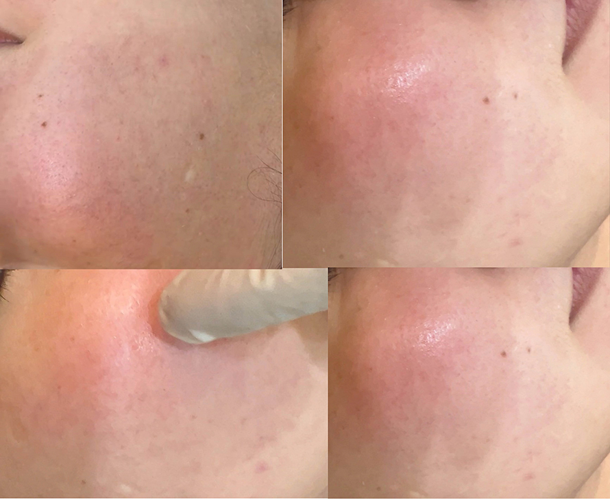 โรคโรซาเชีย Rosacea มีอาการอย่างไร และดูแลรักษาอย่างไร?