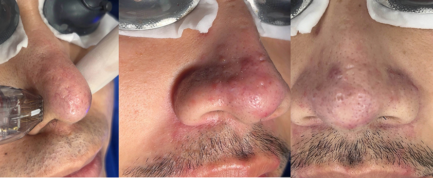 โรคโรซาเชีย Rosacea มีอาการอย่างไร และดูแลรักษาอย่างไร?