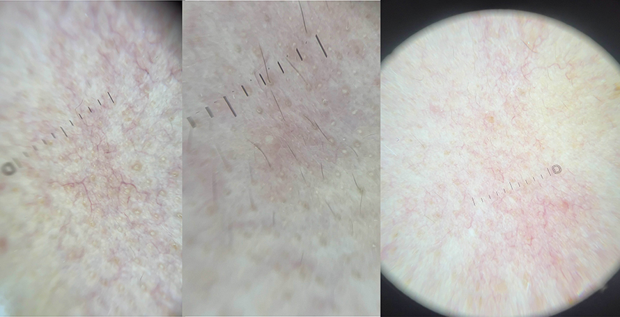 โรคโรซาเชีย Rosacea มีอาการอย่างไร และดูแลรักษาอย่างไร?