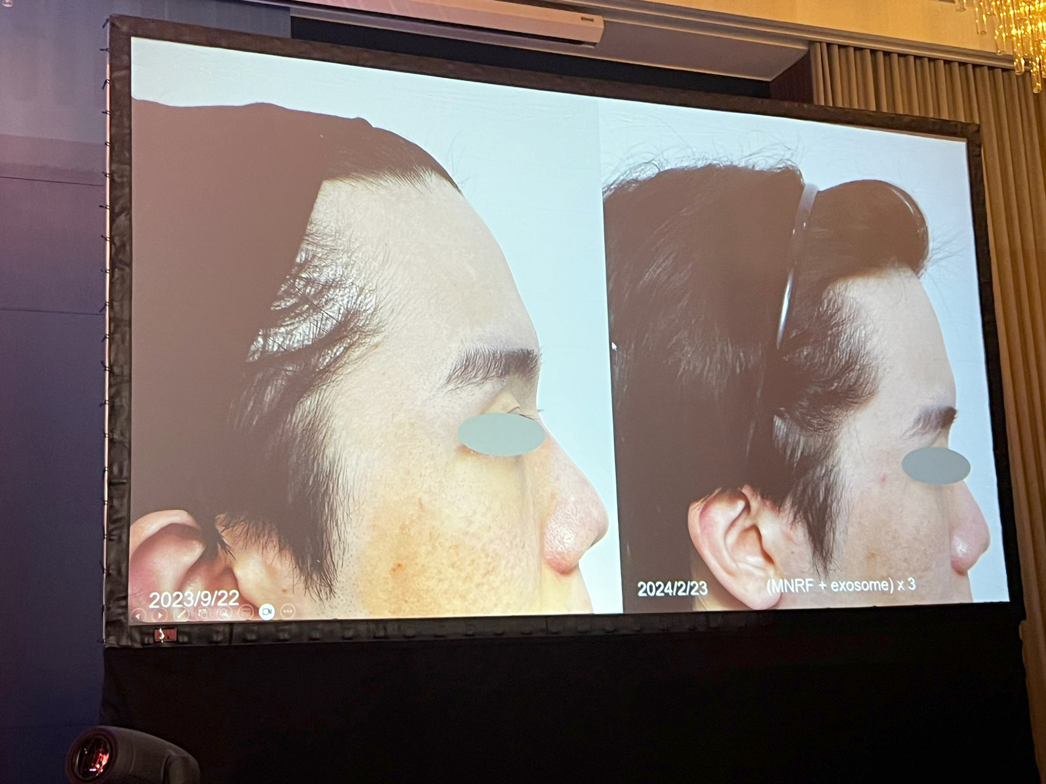 หมอรุจ ผศ. นพ. ศุภะรุจ เลื่องอรุณ ได้รับเกียรติร่วมบรรยายแชร์เทคนิคการดูแลปัญหาผิวหนัง เช่น หลุมสิว แผลเป็น ปัญหาเส้นผม ฝ้า กับแพทย์ผู้เชี่ยวชาญระดับแนวหน้าของประเทศไต้หวัน เช่น หมอรุจ ผศ. นพ. ศุภะรุจ เลื่องอรุณ ได้รับเกียรติร่วมบรรยายแชร์เทคนิคการดูแลปัญหาผิวหนัง เช่น หลุมสิว แผลเป็น ปัญหาเส้นผม ฝ้า กับแพทย์ผู้เชี่ยวชาญระดับแนวหน้าของประเทศไต้หวัน เช่น