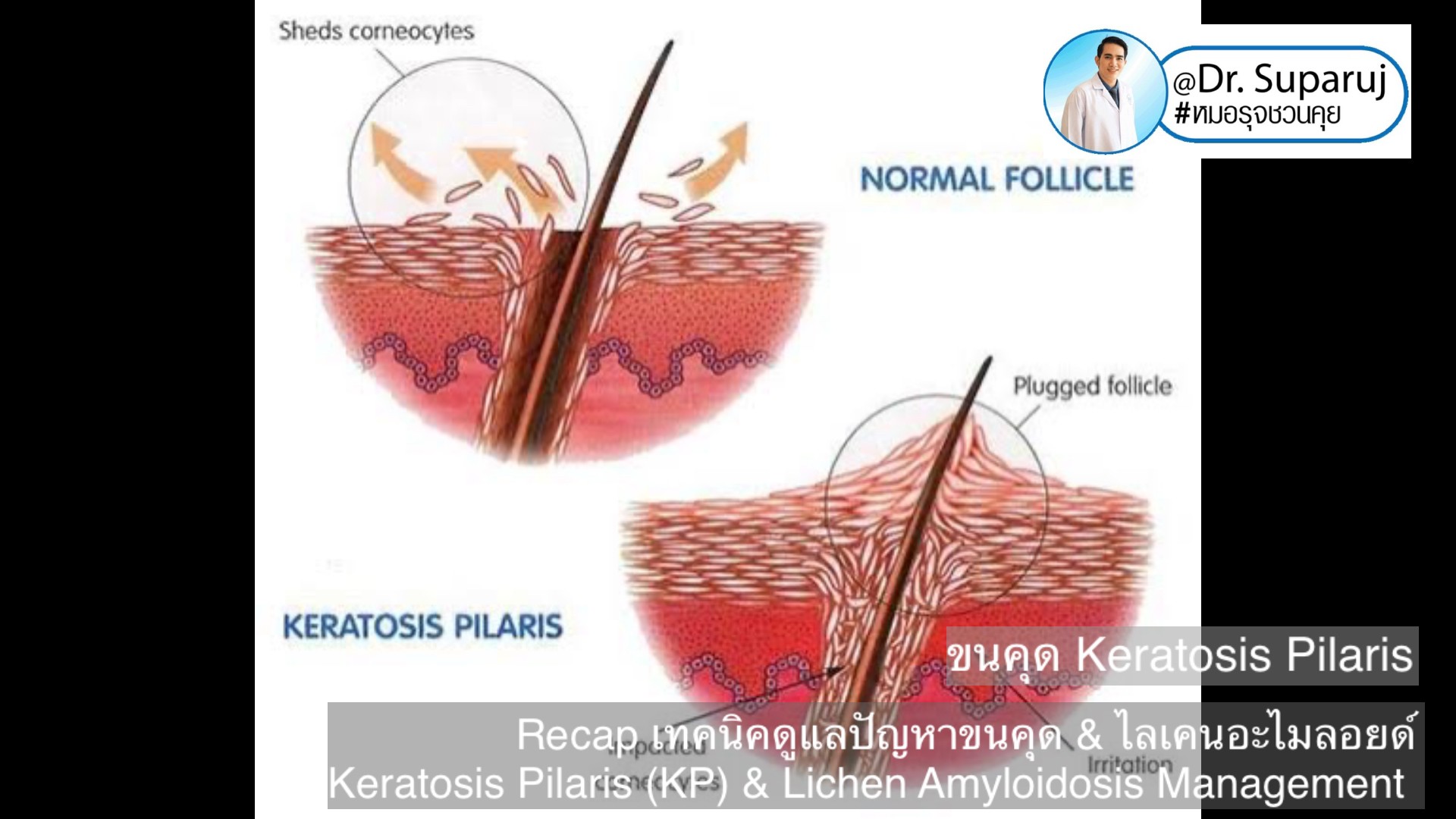 Recap เทคนิคดูแลปัญหาขนคุด & ไลเคนอะไมลอยด์  Keratosis Pilaris (KP) & Lichen Amyloidosis Management