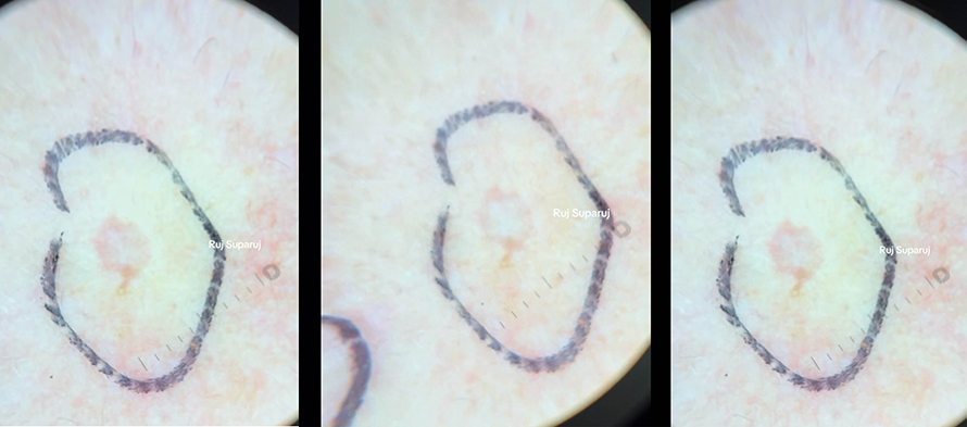 "แผลเป็นหลุมอีสุกอีใส" (Chicken Pox Scars) ลักษณะเฉพาะและการรักษา ? "แผลเป็นหลุมอีสุกอีใส" (Chicken Pox Scars) ลักษณะเฉพาะและการรักษา ?