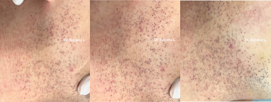 ขนคุดชนิดที่มีรอยแดง Keratosis Pilaris Rubra = KP Rubra มีลักษณะอย่างไร & ดูแลได้อย่างไร ? ขนคุดชนิดที่มีรอยแดง Keratosis Pilaris Rubra = KP Rubra มีลักษณะอย่างไร & ดูแลได้อย่างไร ?