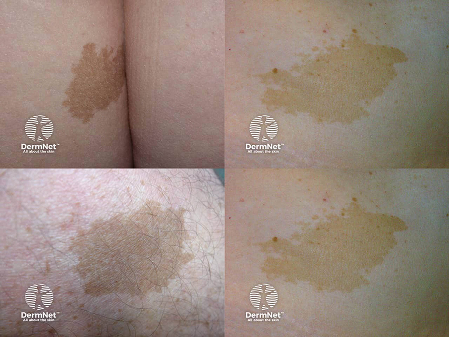 ปานสีน้ำตาล มีลักษณะอย่างไร & ดูแลได้อย่างไร? ปานสีน้ำตาล มีลักษณะอย่างไร & ดูแลได้อย่างไร?