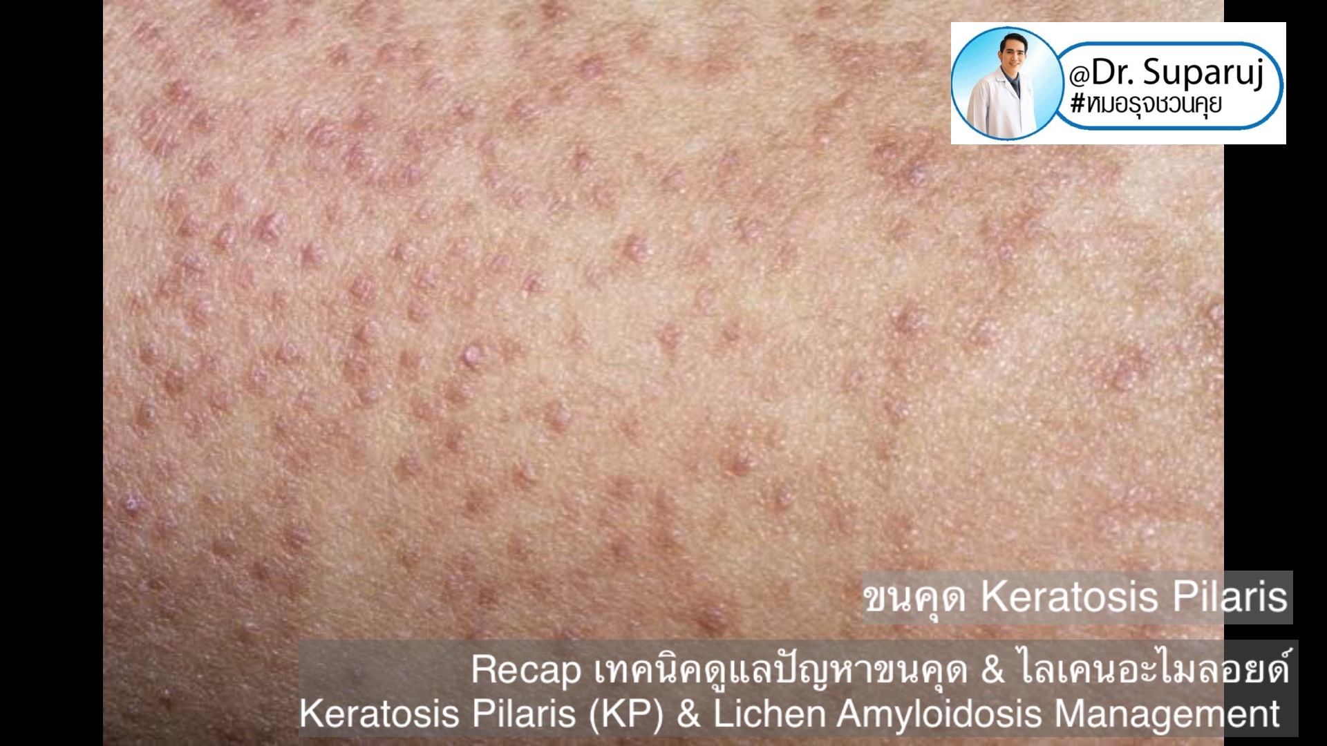 Recap เทคนิคดูแลปัญหาขนคุด & ไลเคนอะไมลอยด์  Keratosis Pilaris (KP) & Lichen Amyloidosis Management