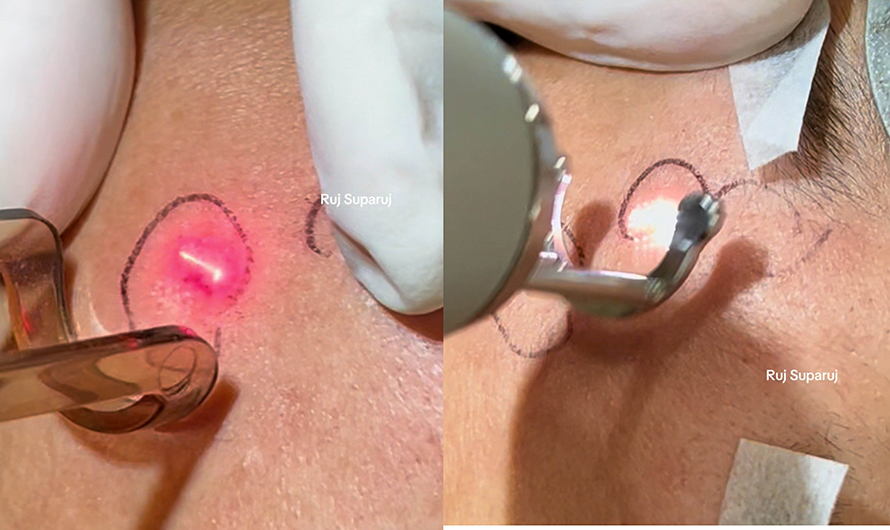 "แผลเป็นหลุมอีสุกอีใส" (Chicken Pox Scars) ลักษณะเฉพาะและการรักษา ?