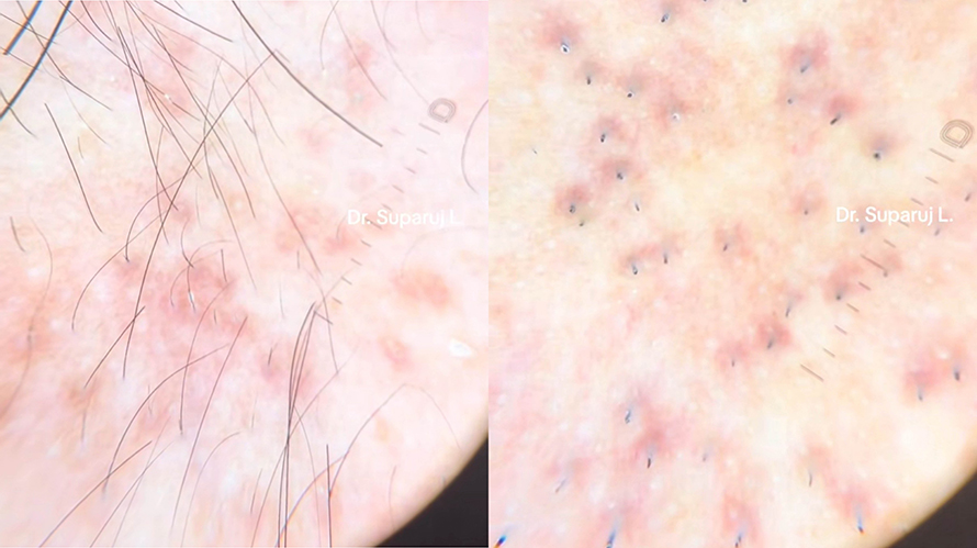 ขนคุดชนิดที่มีรอยแดง Keratosis Pilaris Rubra = KP Rubra มีลักษณะอย่างไร & ดูแลได้อย่างไร ?