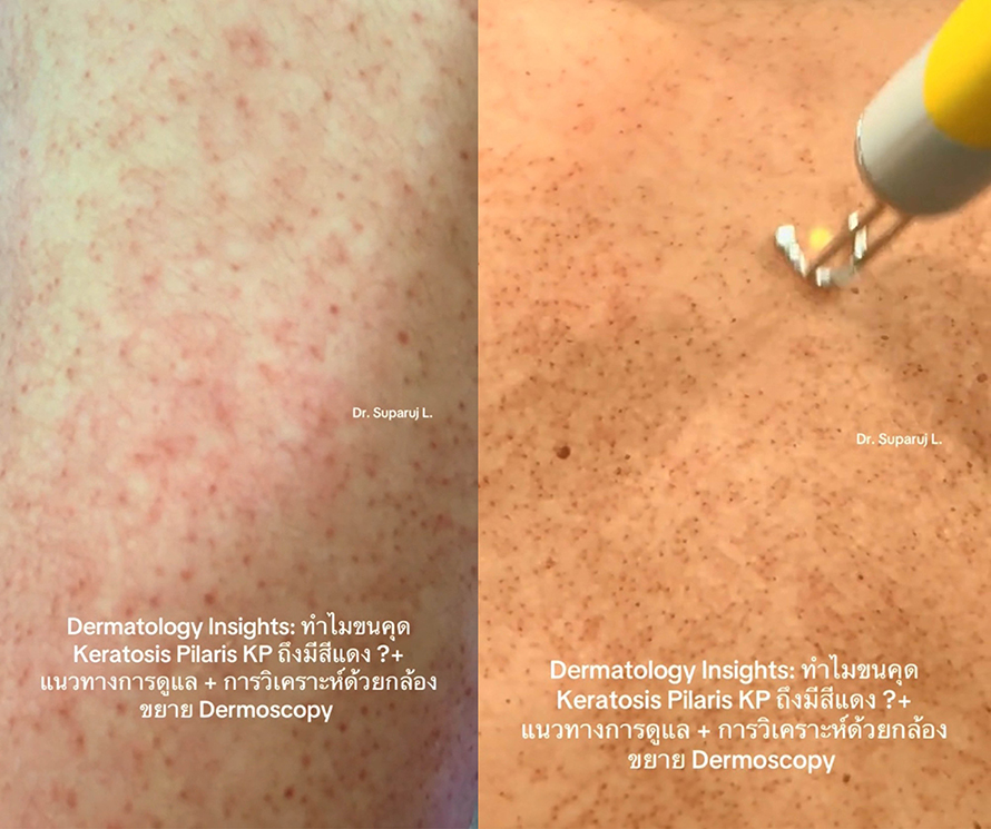 "ทำไมขนคุด Keratosis Pilaris (KP) ถึงมีสีแดง? + แนวทางการดูแล + วิเคราะห์ผิวกล้องส่องขยาย Dermoscopy " วันนี้หมอจะพามาวิเคราะห์ด้วยกล้องขยายผิวหนังหรือ Dermoscopy กันครับ "ทำไมขนคุด Keratosis Pilaris (KP) ถึงมีสีแดง? + แนวทางการดูแล + วิเคราะห์ผิวกล้องส่องขยาย Dermoscopy " วันนี้หมอจะพามาวิเคราะห์ด้วยกล้องขยายผิวหนังหรือ Dermoscopy กันครับ