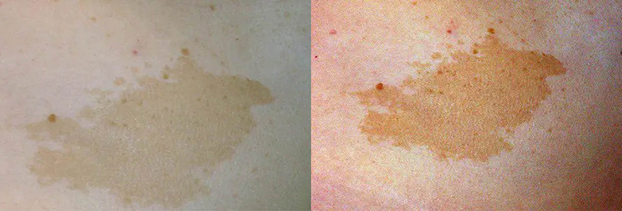 ปานสีน้ำตาล มีลักษณะอย่างไร & ดูแลได้อย่างไร? ปานสีน้ำตาล มีลักษณะอย่างไร & ดูแลได้อย่างไร?