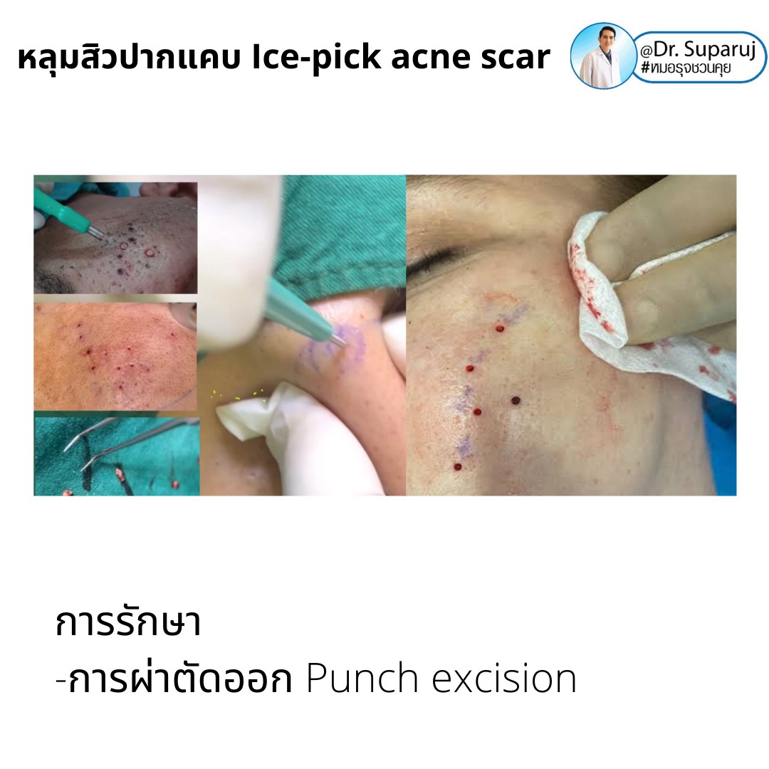 แนะนำเทคนิครักษาหลุมสิวจิกลึก Ice Pick Acne Scar ด้วยเทคนิคเลเซอร์ UltraDeep Pico Technique (Ice Pick Acne Scar Treatment with Discovery Pico Laser + UltraDeep Pico Technique)  แนะนำเทคนิครักษาหลุมสิวจิกลึก Ice Pick Acne Scar ด้วยเทคนิคเลเซอร์ UltraDeep Pico Technique (Ice Pick Acne Scar Treatment with Discovery Pico Laser + UltraDeep Pico Technique)
