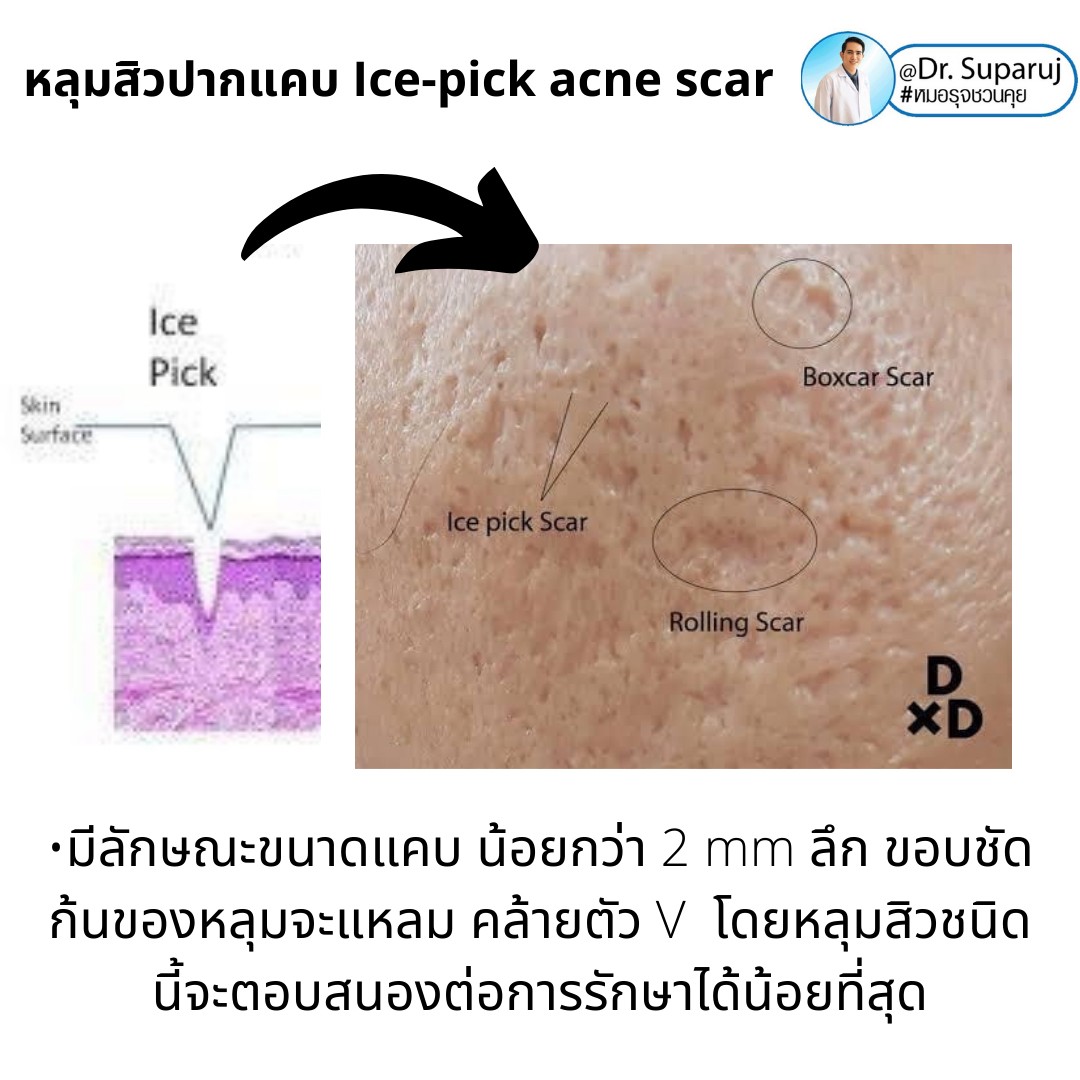 แนะนำเทคนิครักษาหลุมสิวจิกลึก Ice Pick Acne Scar ด้วยเทคนิคเลเซอร์ UltraDeep Pico Technique (Ice Pick Acne Scar Treatment with Discovery Pico Laser + UltraDeep Pico Technique)  แนะนำเทคนิครักษาหลุมสิวจิกลึก Ice Pick Acne Scar ด้วยเทคนิคเลเซอร์ UltraDeep Pico Technique (Ice Pick Acne Scar Treatment with Discovery Pico Laser + UltraDeep Pico Technique)