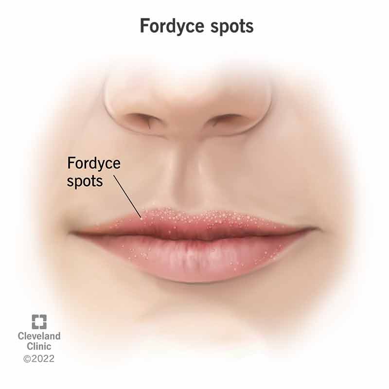 Fordyce Spot ตุ่มไขมันที่ริมฝีปาก คืออะไร มีลักษณะอย่างไร & มีวิธีดูแลได้อย่างไรบ้าง? Fordyce Spot ตุ่มไขมันที่ริมฝีปาก คืออะไร มีลักษณะอย่างไร & มีวิธีดูแลได้อย่างไรบ้าง?
