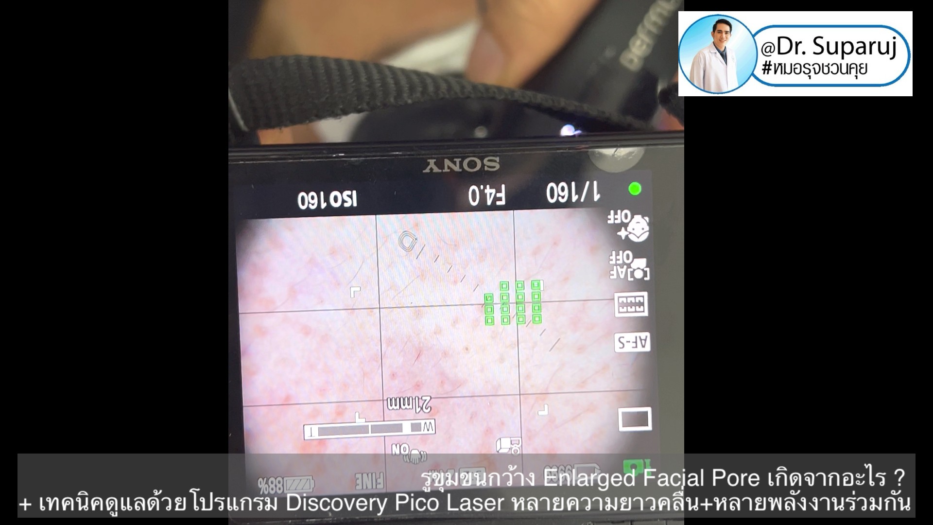 รูขุมขนกว้าง Enlarged Facial Pore เกิดจากอะไร ? + เทคนิคดูแลด้วยโปรแกรม Discovery Pico Laser หลายความยาวคลื่น +หลายพลังงานร่วมกัน