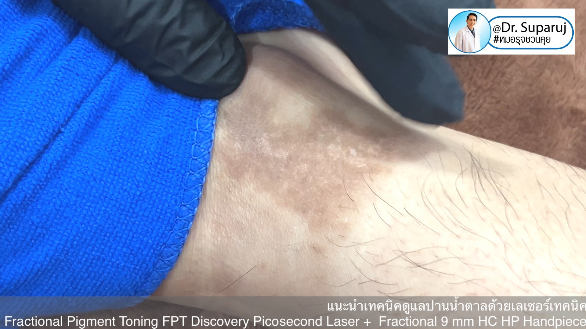 แนะนำเทคนิคดูแลปานน้ำตาล ด้วยเลเซอร์เทคนิค Fractional Pigment Toning FPT Discovery Picosecond Laser + Fractional 9 mm HC HP Handpiece แนะนำเทคนิคดูแลปานน้ำตาล ด้วยเลเซอร์เทคนิค Fractional Pigment Toning FPT Discovery Picosecond Laser + Fractional 9 mm HC HP Handpiece