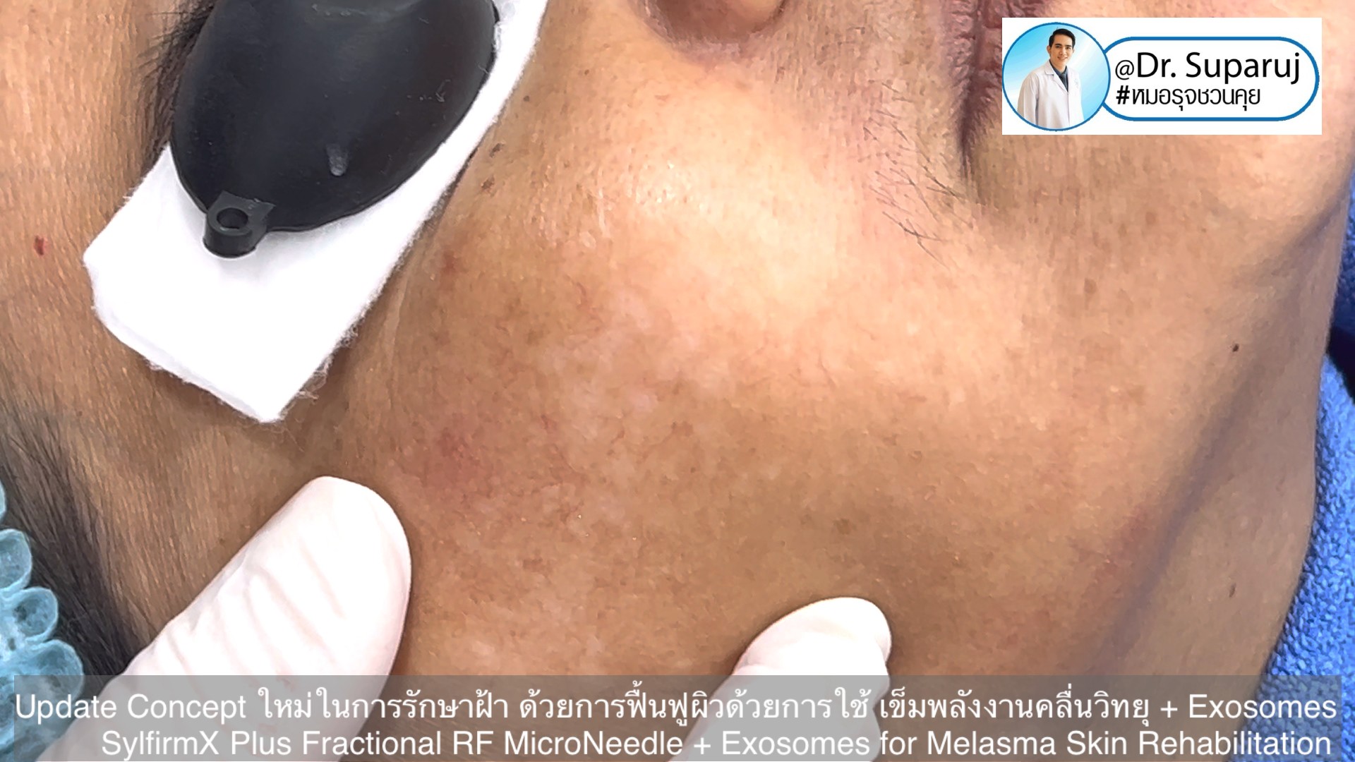 Update Concept ใหม่ในการรักษาฝ้า ด้วยการฟื้นฟูผิวด้วยการใช้ เข็มพลังงานคลื่นวิทยุ + Exosomes (SylfirmX Plus Fractional RF MicroNeedle + Exosomes for Melasma Skin Rehabilitation) Update Concept ใหม่ในการรักษาฝ้า ด้วยการฟื้นฟูผิวด้วยการใช้ เข็มพลังงานคลื่นวิทยุ + Exosomes (SylfirmX Plus Fractional RF MicroNeedle + Exosomes for Melasma Skin Rehabilitation)