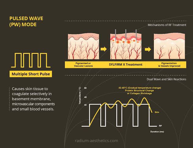 Update Concept ใหม่ในการรักษาฝ้า ด้วยการฟื้นฟูผิวด้วยการใช้ เข็มพลังงานคลื่นวิทยุ + Exosomes (SylfirmX Plus Fractional RF MicroNeedle + Exosomes for Melasma Skin Rehabilitation) Update Concept ใหม่ในการรักษาฝ้า ด้วยการฟื้นฟูผิวด้วยการใช้ เข็มพลังงานคลื่นวิทยุ + Exosomes (SylfirmX Plus Fractional RF MicroNeedle + Exosomes for Melasma Skin Rehabilitation)