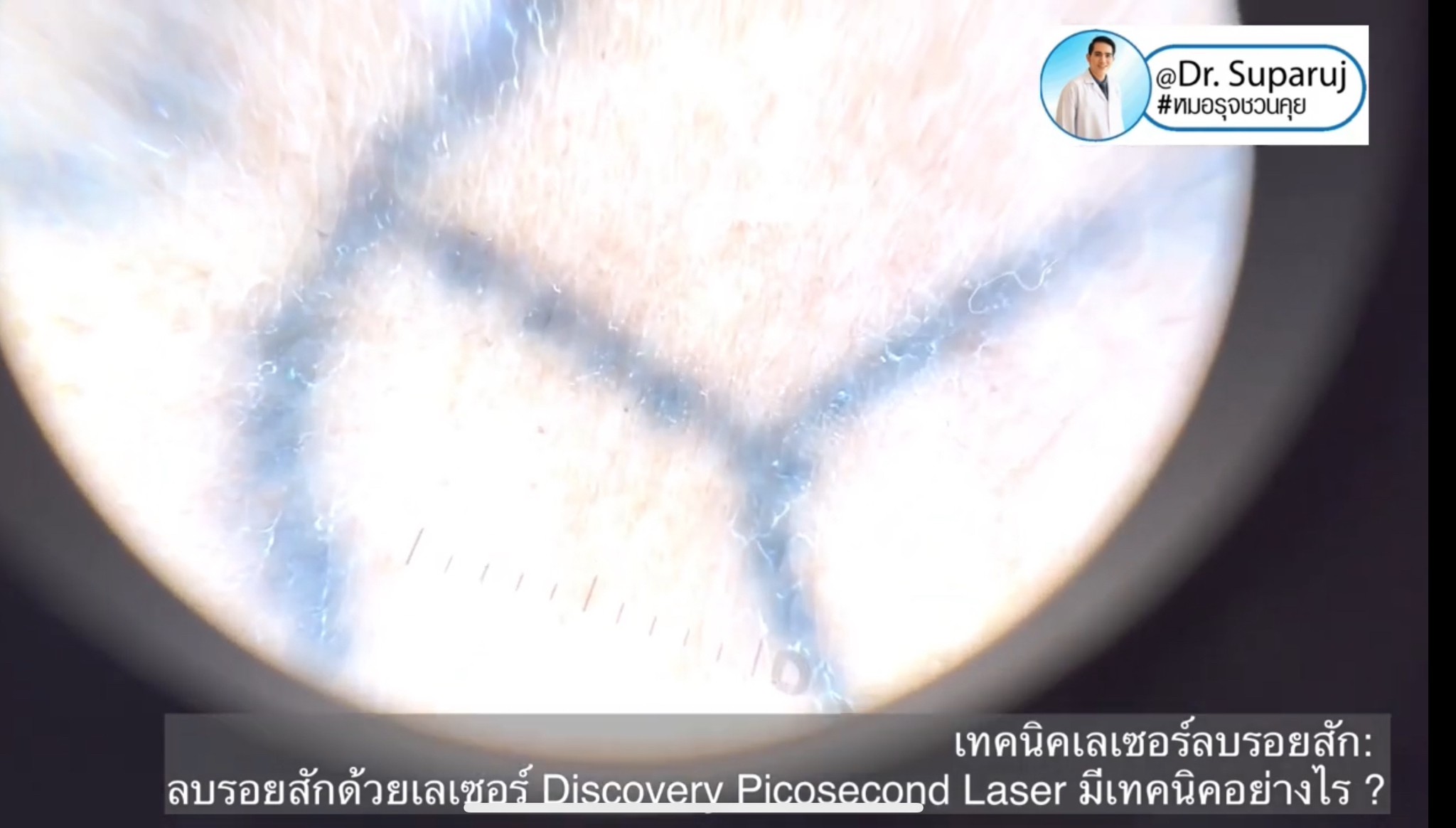 ทำไมต้องลบรอยสักด้วย พิโค่เลเซอร์ Picosecond Laser