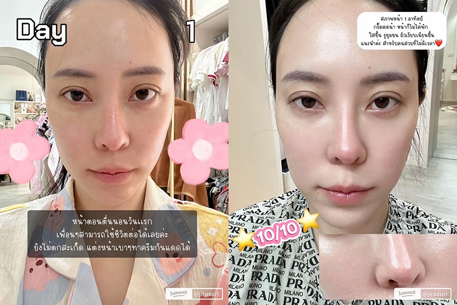 ขอบคุณคุณจูน @jirasuri มากนะครับที่ไว้วางใจให้หมอได้ดูแลปัญหาเรื่องรูขุมขนและจุดด่างดำด้วย โปรแกรม LaserME ครับผม ขอบคุณคุณจูน @jirasuri มากนะครับที่ไว้วางใจให้หมอได้ดูแลปัญหาเรื่องรูขุมขนและจุดด่างดำด้วย โปรแกรม LaserME ครับผม