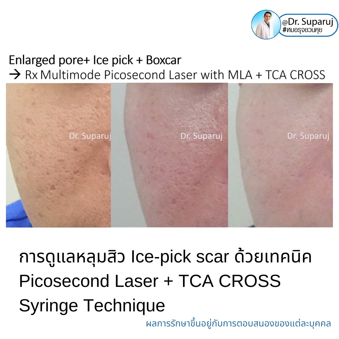 แนะนำเทคนิครักษาหลุมสิวจิกลึก Ice Pick Acne Scar ด้วยเทคนิคเลเซอร์ UltraDeep Pico Technique (Ice Pick Acne Scar Treatment with Discovery Pico Laser + UltraDeep Pico Technique)  แนะนำเทคนิครักษาหลุมสิวจิกลึก Ice Pick Acne Scar ด้วยเทคนิคเลเซอร์ UltraDeep Pico Technique (Ice Pick Acne Scar Treatment with Discovery Pico Laser + UltraDeep Pico Technique)