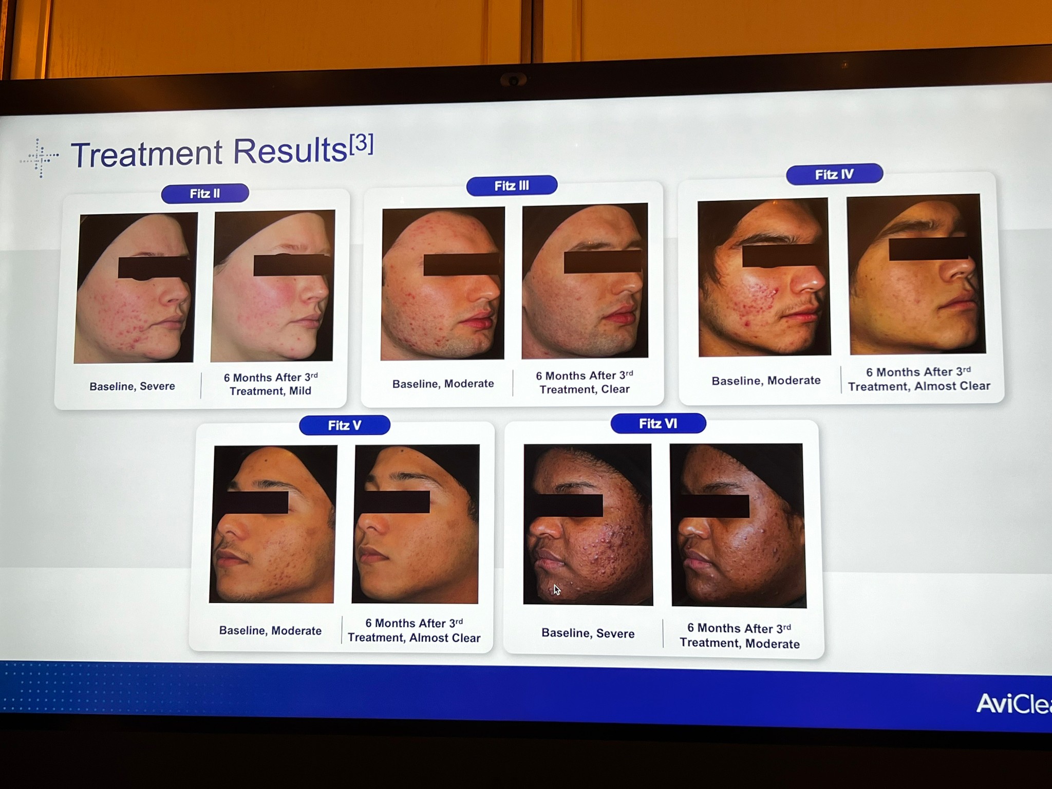 Update เครื่องเลเซอร์สำหรับรักษาสิวโดยเฉพาะ จับกับต่อมไขมันโดยตรง = AviClear 1726 nm Laser Update เครื่องเลเซอร์สำหรับรักษาสิวโดยเฉพาะ จับกับต่อมไขมันโดยตรง = AviClear 1726 nm Laser