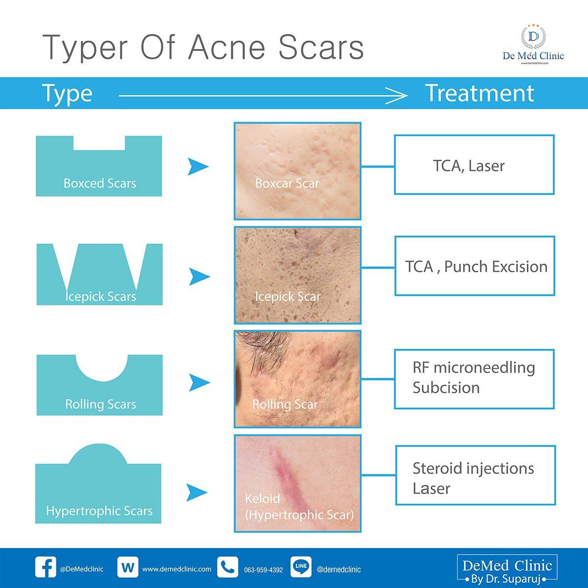 Update เทคนิครักษาหลุมสิว: หลุมสิวแบบจิกลึก Ice Pick Acne Scar มีลักษณะ & ดูแลได้อย่างไร ? Update เทคนิครักษาหลุมสิว: หลุมสิวแบบจิกลึก Ice Pick Acne Scar มีลักษณะ & ดูแลได้อย่างไร ?